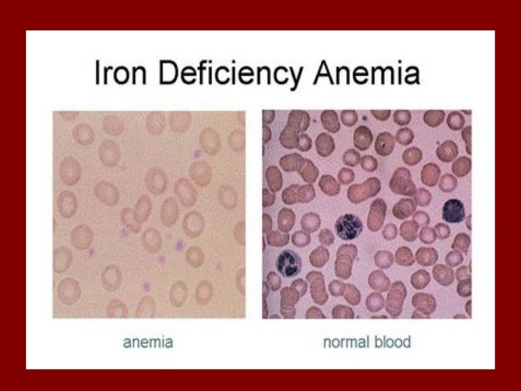 Nutritional anemia
