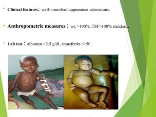  Clinical features: well-nourished appearance edematous.
 Anthropometric measures : wt. >100%, TSF>100% standard.
 Lab test : albumen <3.5 g/dl , transferrin <150.
 