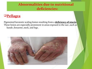 Abnormalities due to nutritional
deficiencies:
Pellagra
Pigmented keratotic scaling lesion resulting from a deficiency of niacin.
These lesion are especially prominent in areas exposed to the sun ,such as
hands ,forearms ,neck, and legs .
 