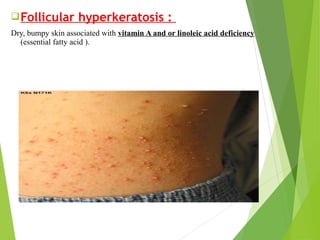 Follicular hyperkeratosis :
Dry, bumpy skin associated with vitamin A and or linoleic acid deficiency
(essential fatty acid ).
 