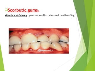 Scorbutic gums:
vitamin c deficiency. gums are swollen , ulcerated , and bleeding.
 
