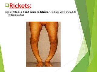 Rickets:
sign of vitamin d and calcium deficiencies in children and adult
(osteomalacia)
 