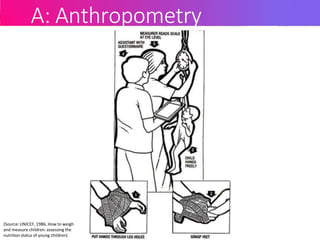 A: Anthropometry
(Source: UNICEF, 1986, How to weigh
and measure children: assessing the
nutrition status of young children)
 