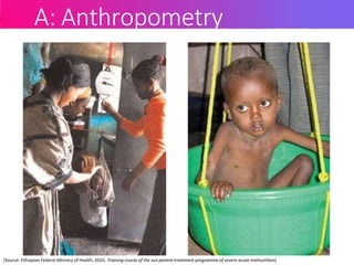 A: Anthropometry
(Source: Ethiopian Federal Ministry of Health, 2010, Training course of the out patient treatment programme of severe acute malnutrition)
 
