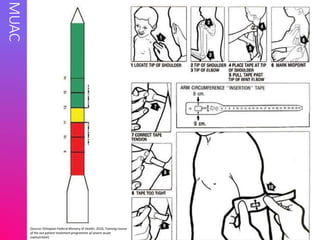 MUAC
(Source:Ethiopian Federal Ministry of Health, 2010, Training course
of the out patient treatment programme of severe acute
malnutrition)
 