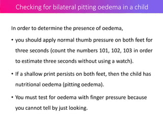 Checking for bilateral pitting oedema in a child
In order to determine the presence of oedema,
• you should apply normal thumb pressure on both feet for
three seconds (count the numbers 101, 102, 103 in order
to estimate three seconds without using a watch).
• If a shallow print persists on both feet, then the child has
nutritional oedema (pitting oedema).
• You must test for oedema with finger pressure because
you cannot tell by just looking.
 