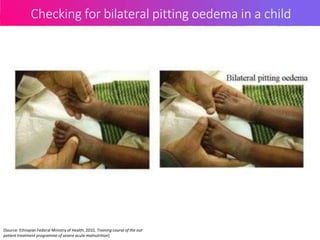 Checking for bilateral pitting oedema in a child
(Source: Ethiopian Federal Ministry of Health, 2010, Training course of the out
patient treatment programme of severe acute malnutrition)
 