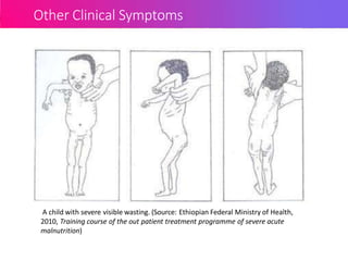 Other Clinical Symptoms
A child with severe visible wasting. (Source: Ethiopian Federal Ministry of Health,
2010, Training course of the out patient treatment programme of severe acute
malnutrition)
 