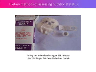 Dietary methods of assessing nutritional status
Testing salt iodine level using an SSK. (Photo:
UNICEF Ethiopia / Dr Tewoldeberhan Daniel)
 
