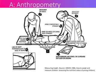 A: Anthropometry
Measuring length. (Source: UNICEF, 1986, How to weigh and
measure children: assessing the nutrition status of young children)
 