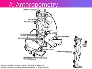 A: Anthropometry
Measuring height. (Source: UNICEF, 1986, How to weigh and
measure children: assessing the nutrition status of young children)
 