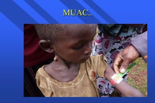 MUAC..
 