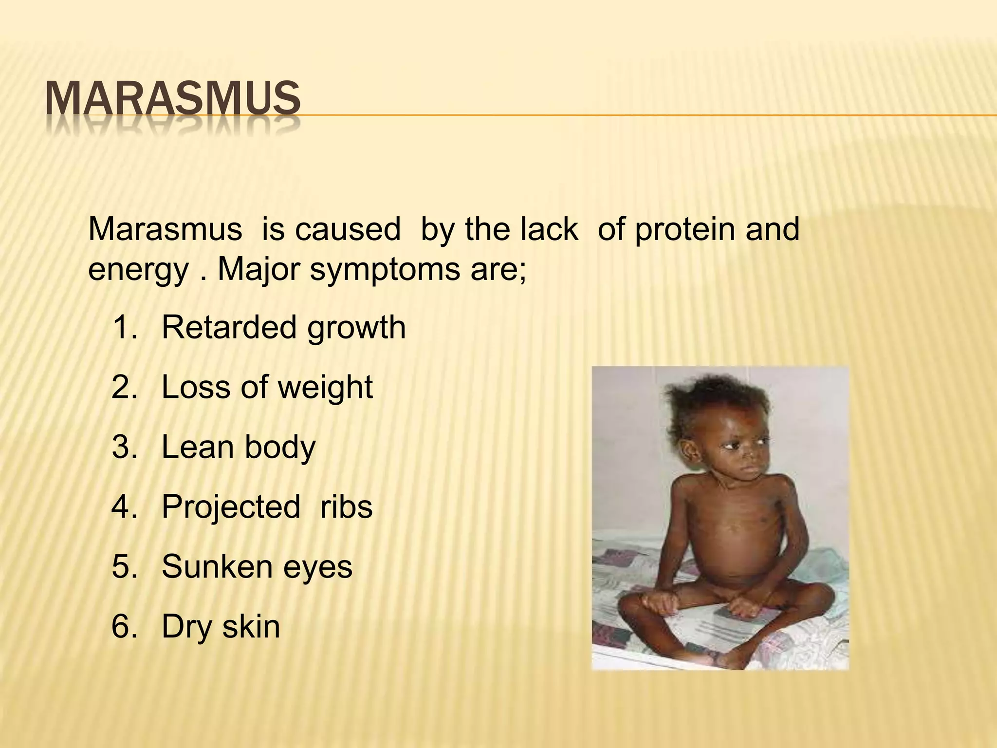 MARASMUS
Marasmus is caused by the lack of protein and
energy . Major symptoms are;
1. Retarded growth
2. Loss of weight
3. Lean body
4. Projected ribs
5. Sunken eyes
6. Dry skin