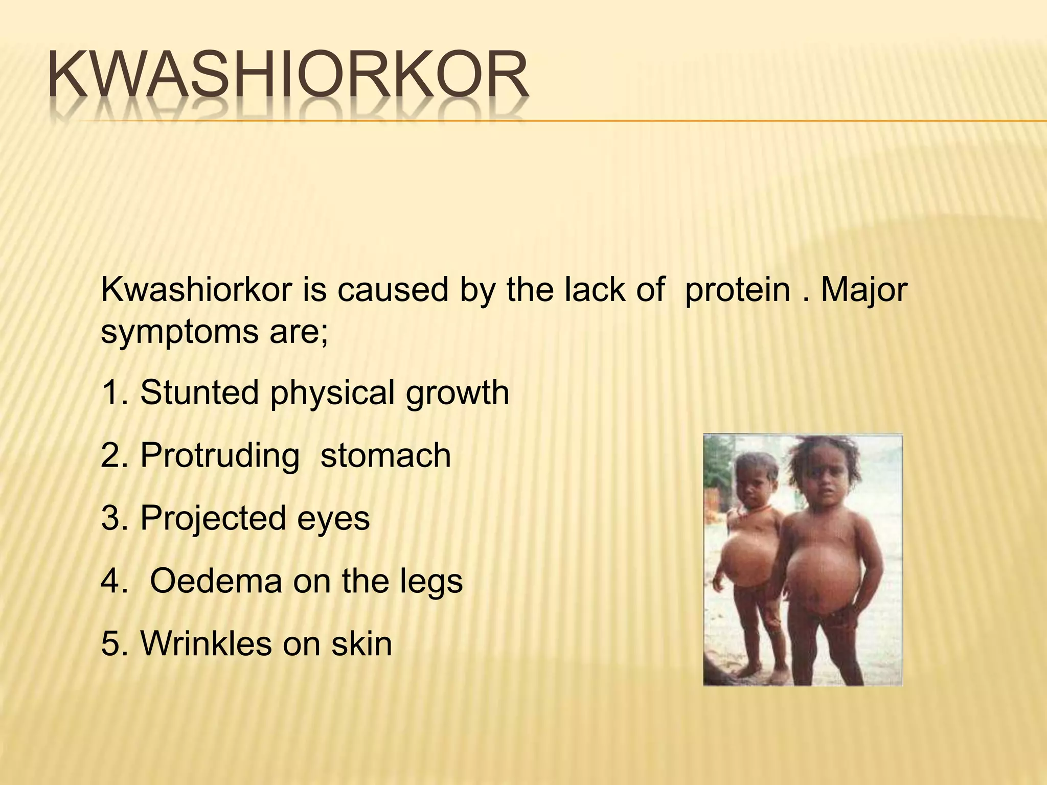 KWASHIORKOR
Kwashiorkor is caused by the lack of protein . Major
symptoms are;
1. Stunted physical growth
2. Protruding stomach
3. Projected eyes
4. Oedema on the legs
5. Wrinkles on skin