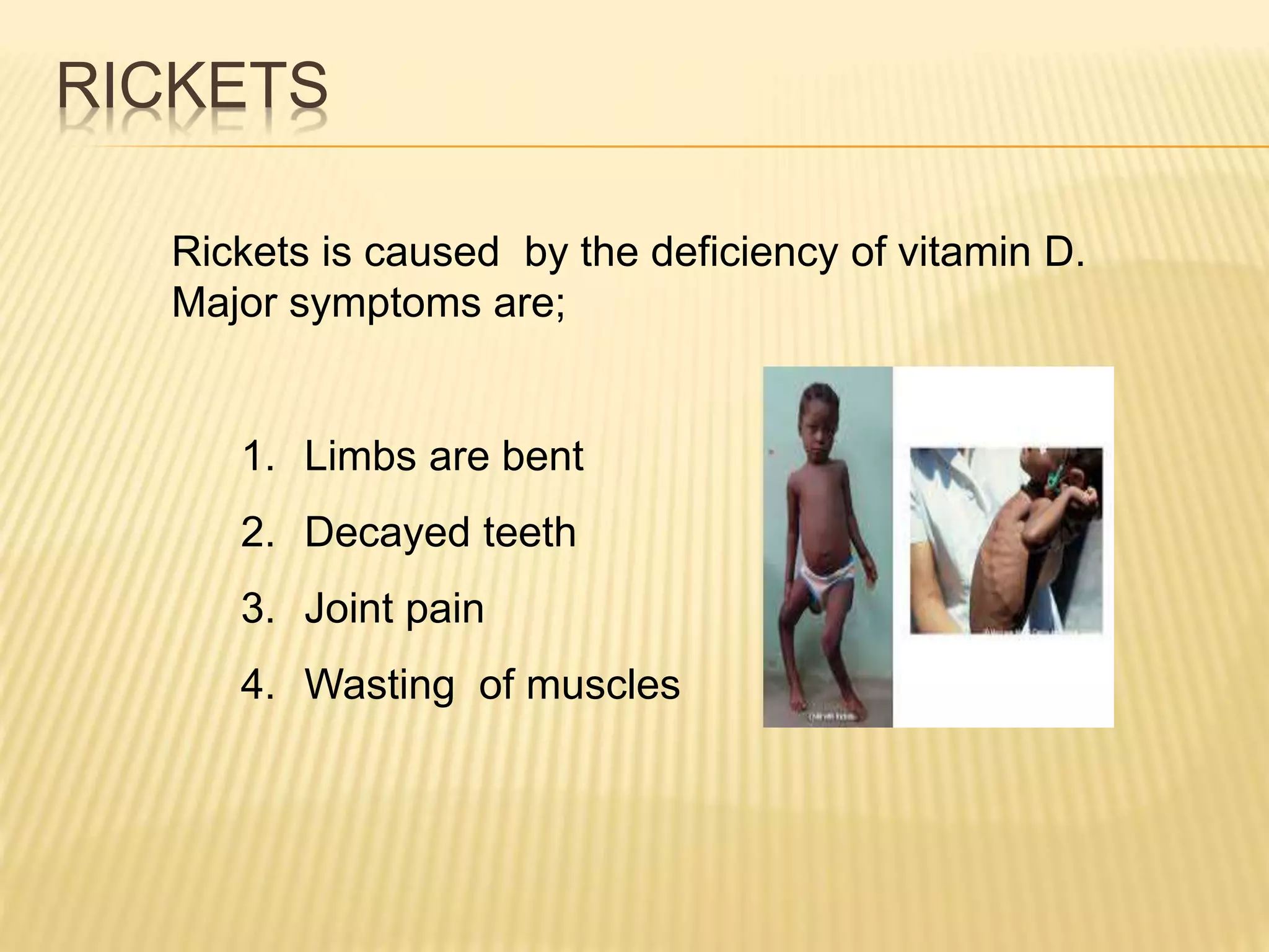 RICKETS
Rickets is caused by the deficiency of vitamin D.
Major symptoms are;
1. Limbs are bent
2. Decayed teeth
3. Joint pain
4. Wasting of muscles