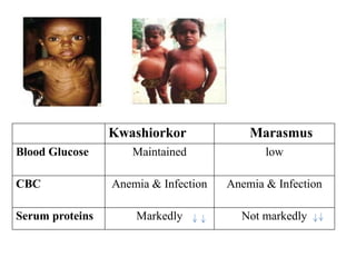 Kwashiorkor Marasmus
Blood Glucose Maintained low
CBC Anemia & Infection Anemia & Infection
Serum proteins Markedly Not markedly
 