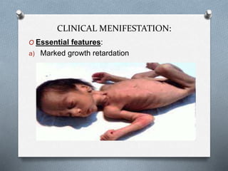 CLINICAL MENIFESTATION:
O Essential features:
a) Marked growth retardation
 