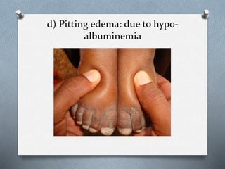 d) Pitting edema: due to hypo-
albuminemia
 