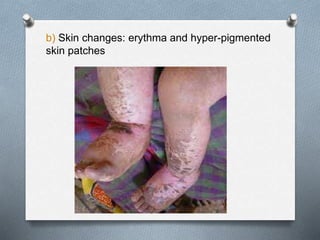 b) Skin changes: erythma and hyper-pigmented
skin patches
 
