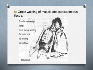 b) Gross wasting of muscle and subcutaneous
tissue:
 