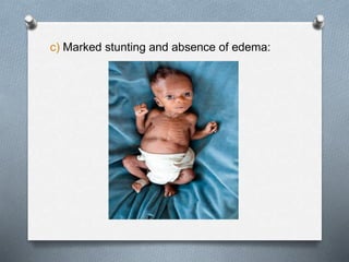 c) Marked stunting and absence of edema:
 