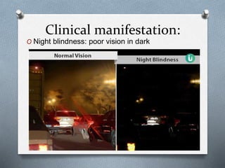 Clinical manifestation:
O Night blindness: poor vision in dark
 