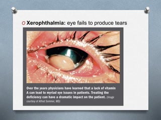 O Xerophthalmia: eye fails to produce tears
 