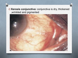 O Xerosis conjunctiva: conjunctiva is dry, thickened
,wrinkled and pigmented
 