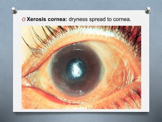 O Xerosis cornea: dryness spread to cornea.
 