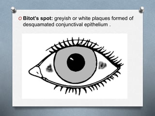 O Bitot’s spot: greyish or white plaques formed of
desquamated conjunctival epithelium .
 