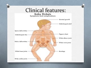 Clinical features:
 