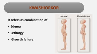 Enter title
It refers as combination of
• Edema
• Lethargy
• Growth failure.
KWASHIORKOR
 