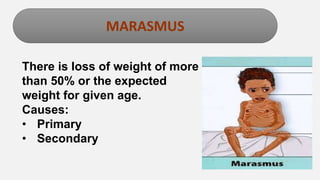 Enter title
MARASMUS
There is loss of weight of more
than 50% or the expected
weight for given age.
Causes:
• Primary
• Secondary
 