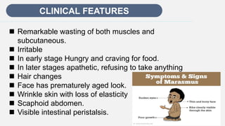 Enter title
CLINICAL FEATURES
 Remarkable wasting of both muscles and
subcutaneous.
 Irritable
 In early stage Hungry and craving for food.
 In later stages apathetic, refusing to take anything
 Hair changes
 Face has prematurely aged look.
 Wrinkle skin with loss of elasticity
 Scaphoid abdomen.
 Visible intestinal peristalsis.
 