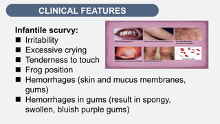 Enter title
CLINICAL FEATURES
Infantile scurvy:
 Irritability
 Excessive crying
 Tenderness to touch
 Frog position
 Hemorrhages (skin and mucus membranes,
gums)
 Hemorrhages in gums (result in spongy,
swollen, bluish purple gums)
 
