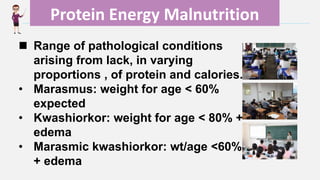 Enter title
Protein Energy Malnutrition
 Range of pathological conditions
arising from lack, in varying
proportions , of protein and calories.
• Marasmus: weight for age < 60%
expected
• Kwashiorkor: weight for age < 80% +
edema
• Marasmic kwashiorkor: wt/age <60%
+ edema
 