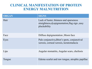 CLINICAL MANIFESTATION OF PROTEIN
ENERGY MALNUTRITION
ORGAN SIGNS
Hair Lack of luster, thinness and sparseness
straightness,dyspigmentation,flag sign ,easy
pluckability
Face Diffuse depigmentation ,Moon face
Eyes Pale conjunctiva,Bitot’s spots, conjunctival
xerosis, corneal xerosis, keratomalacia
Lips Angular stomatitis, Angular scars, cheilosis
Tongue Edema scarlet and raw tongue, atrophic papillae
 