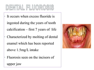 • It occurs when excess fluoride is
ingested during the years of tooth
calcification – first 7 years of life
• Characterized by molting of dental
enamel which has been reported
above 1.5mg/L intake
• Fluorosis seen on the incisors of
upper jaw
 
