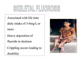 • Associated with life time
daily intake of 3-6mg/L or
more
• Heavy deposition of
fluoride in skeleton
• Crippling occurs leading to
disability
 