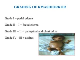 GRADING OF KWASHIORKOR
Grade I – pedal edema
Grade II – I + facial edema
Grade III – II + paraspinal and chest edma,
Grade IV –III + ascites
 