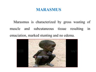 MARASMUS
Marasmus is characterized by gross wasting of
muscle and subcutaneous tissue resulting in
emaciation, marked stunting and no edema.
 
