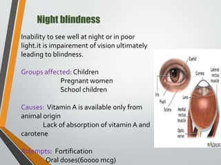 Night blindness
Inability to see well at night or in poor
light.it is impairement of vision ultimately
leading to blindness.
Groups affected: Children
Pregnant women
School children
Causes: Vitamin A is available only from
animal origin
Lack of absorption of vitamin A and
carotene
Attempts: Fortification
Oral doses(60000 mcg)
 