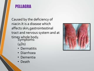 PELLAGRA
Caused by the deficiency of
niacin.It is a disease which
affects skin,gastrointestinal
tract and nervous system and at
times whole body.
Symptoms:
(4Ds)
• Dermatitis
• Diarrhoea
• Dementia
• Death
 