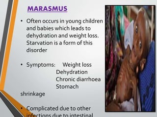MARASMUS
• Often occurs in young children
and babies which leads to
dehydration and weight loss.
Starvation is a form of this
disorder
• Symptoms: Weight loss
Dehydration
Chronic diarrhoea
Stomach
shrinkage
• Complicated due to other
 