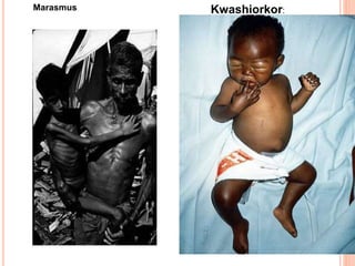 Kwashiorkor:Marasmus
 