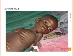 MARASMUS
3/8/2019
NUT
RITI
ONA
L
DIS
ORD
ERS
14
 