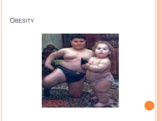 OBESITY
34
 