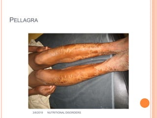 PELLAGRA
3/8/2019 NUTRITIONAL DISORDERS 39
 