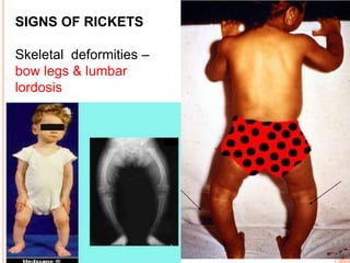 SIGNS OF RICKETS
Skeletal deformities –
bow legs & lumbar
lordosis
 