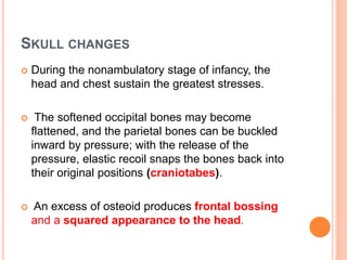 SKULL CHANGES
 During the nonambulatory stage of infancy, the
head and chest sustain the greatest stresses.
 The softened occipital bones may become
flattened, and the parietal bones can be buckled
inward by pressure; with the release of the
pressure, elastic recoil snaps the bones back into
their original positions (craniotabes).
 An excess of osteoid produces frontal bossing
and a squared appearance to the head.
 